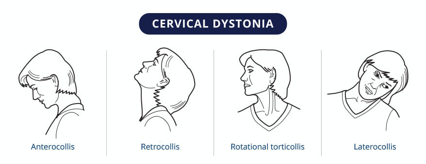 CERVICAL DYSTONIA - Anterocollis - Retrocollis - Rotational torticollis - Laterocollis