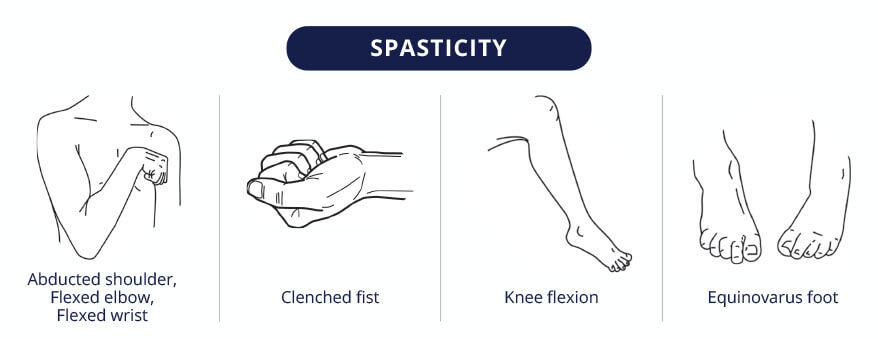 SPASTICITY - Abducted shoulder, Flexed elbow, Flexed wrist -  Clenched fist - Knee flexion - Equinovarus foot